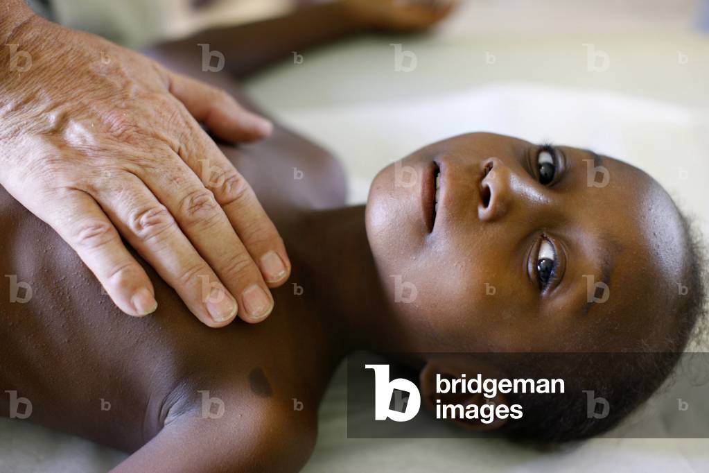 Haitian child with a cardiac malformation, Port-au-Prince, Haiti