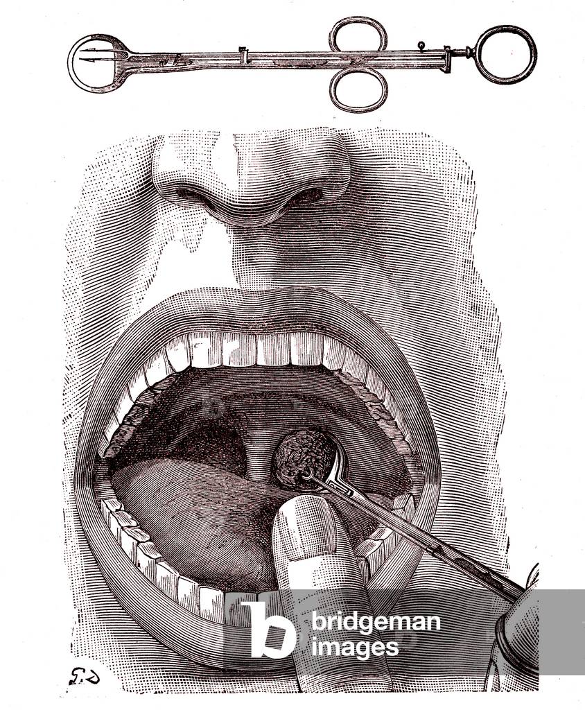 Tonsillectomy. 1887 (engraving)