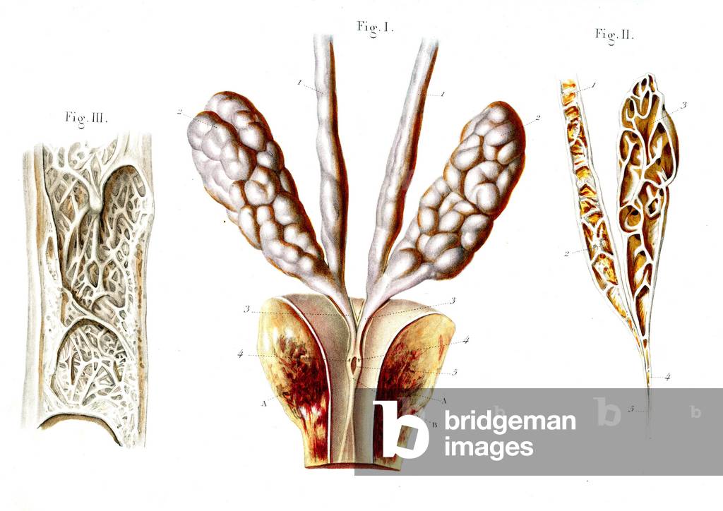 Ejaculatory system 1866 illustrations showing details of the organs involved in the production of semen Fig 1: the seminal vesicles (oval, left and right), vas deferens (tubes, top) and ejaculatory duct (small oval hole, lower centre) Fig 2: cross-section through one of the vas deferens (tube, left) and seminal vesicles (oval, right through) Fig 3: cross-section showing the internal surface of one of the vas deferens The seminal vesicles secrete a significant proportion of the fluid that ultimately becomes semen The vas deferens transport sperm from the epididymis of the testes to the ejaculatory ducts in anticipation of ejaculation The two ejaculatory ducts are formed by the union of the vas deferens with the duct of the seminal vesicles Canal deferent, seminal vesicle, injecting ejaculating canal - Fig 1: Canal deferent, seminal vesicle and ejaculating canal, Fig 2: Cutting of channel and vesicle, Fig 3: Internal surface of channel deferent - 1866