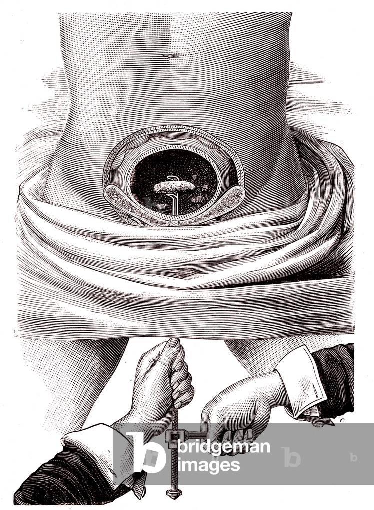 Lithiasis.Stony calculations and concretions. 1887 (engraving)
