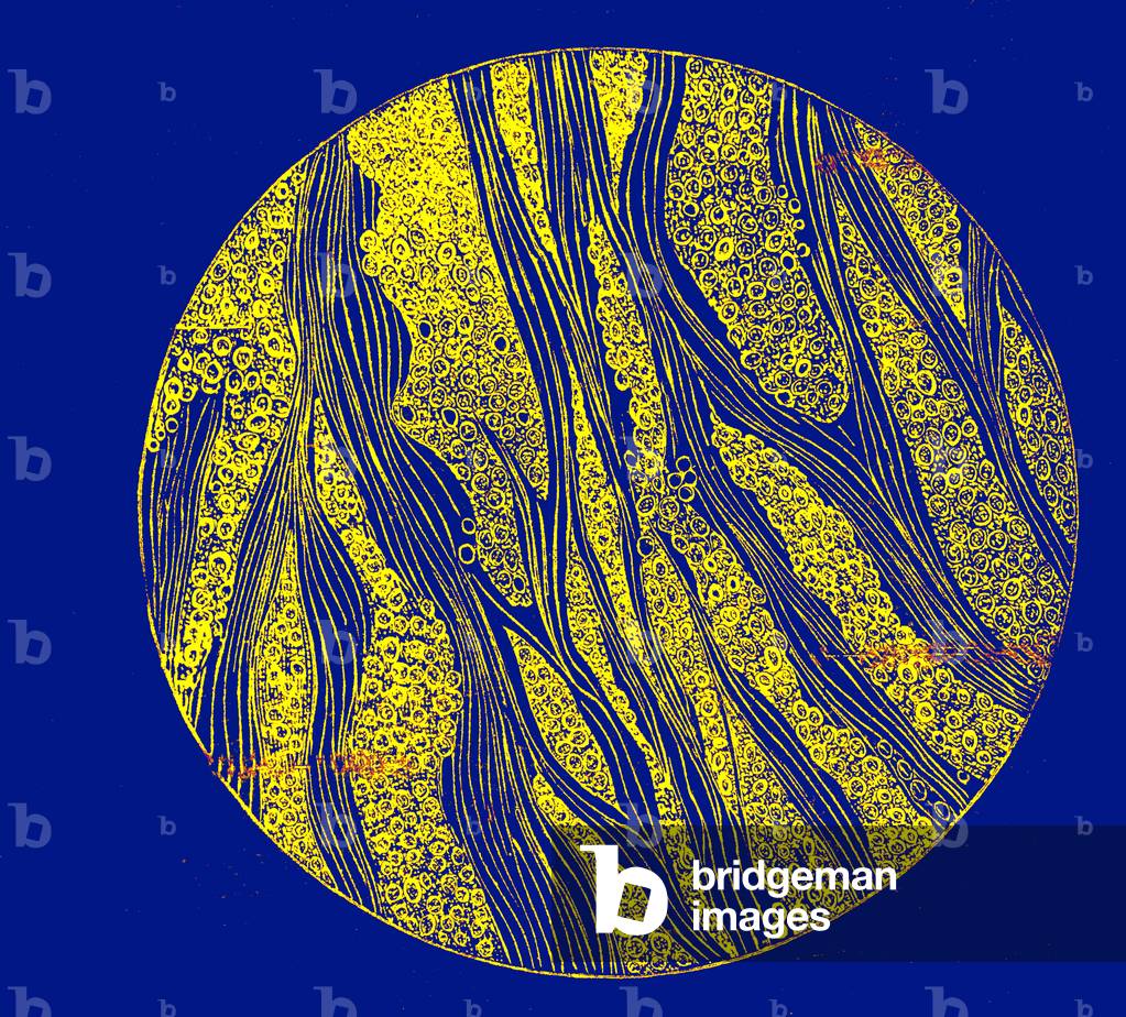 Section of squirrous cancer (X 100% ), 
1877