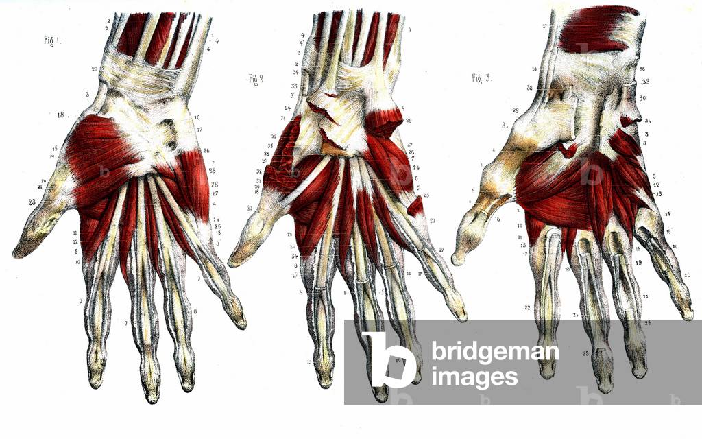 Human hand - 1866 anatomical illustration showing the muscles (brown) and tendons (white) of the human hand - Region palmar- Anatomy - Fig 1 Cubital anterieur Fig 2 cubital anterieur et grand palmar, Fig 3 Muscle adducteur du thumb, 1866