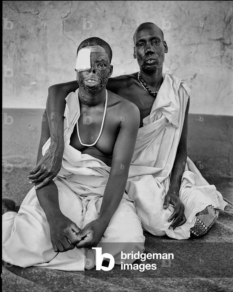 Mother and daughter - the daughter with burns from falling in a fire after having a fit brought on by panic as her village was under attack, northern Kenya, Africa (b/w photo)