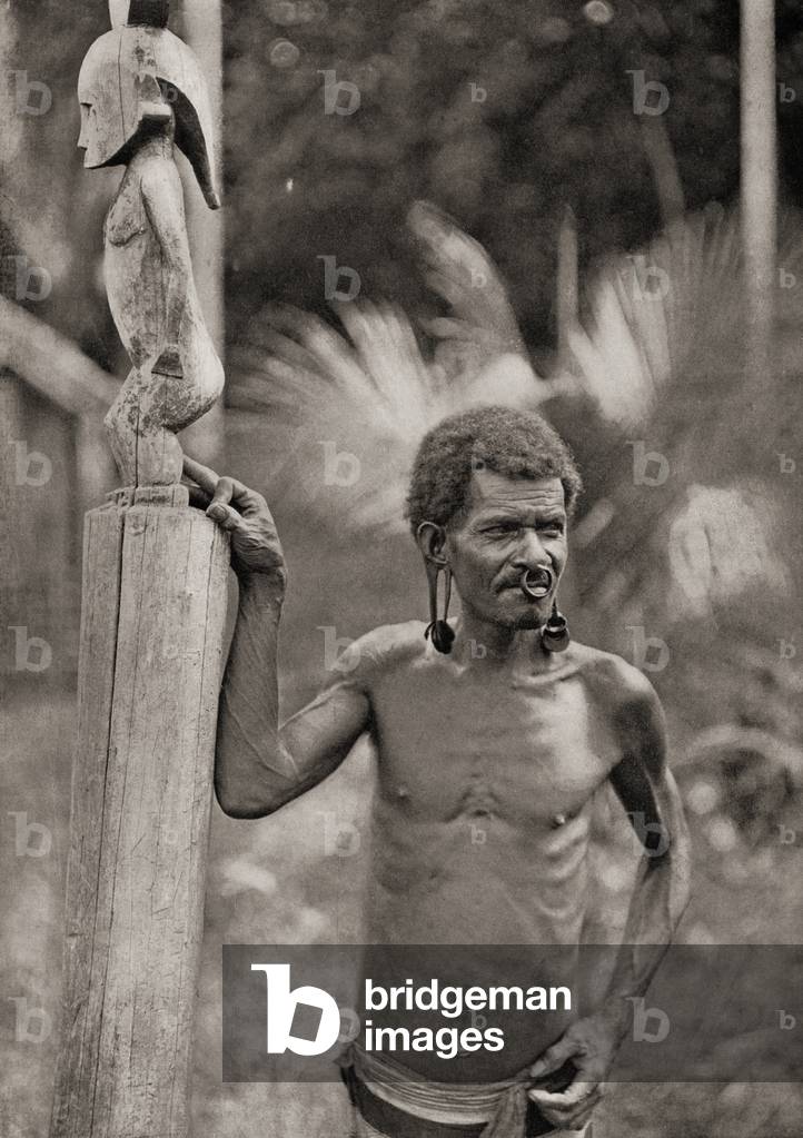 Malformation of the ears.  A man from the  Solomon Islands with pierced ear lobes which are enlarged by discs, and wearing a nose ring. After a 19th century photograph.  From Customs of The World, published c.1913.