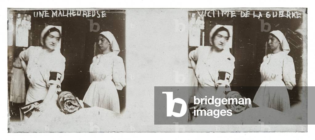 Victim of the War, Nurses with an injured soldier, Gueule cassee, Stereoscopic view, First World War (sepia photo)