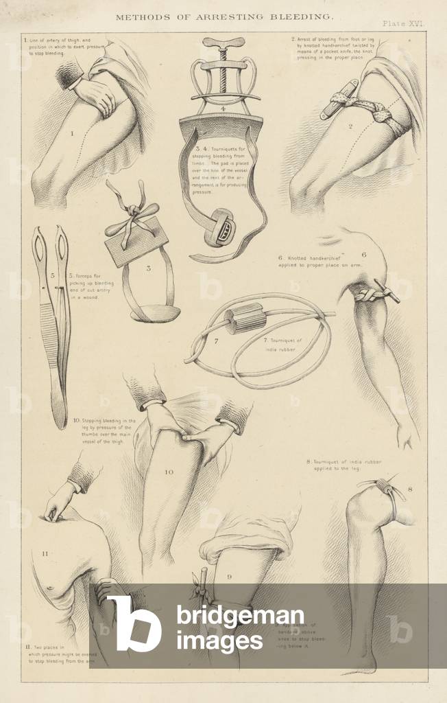 Methods of arresting bleeding (engraving)