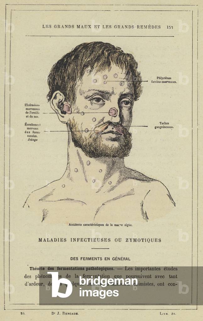 Accidents caracteristiques de la morve aigue (colour litho)
