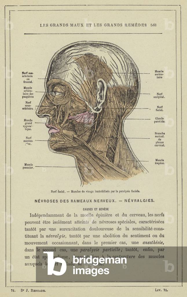 Nerf facial, Muscles du visage immobilises par la paralysie faciale (colour litho)