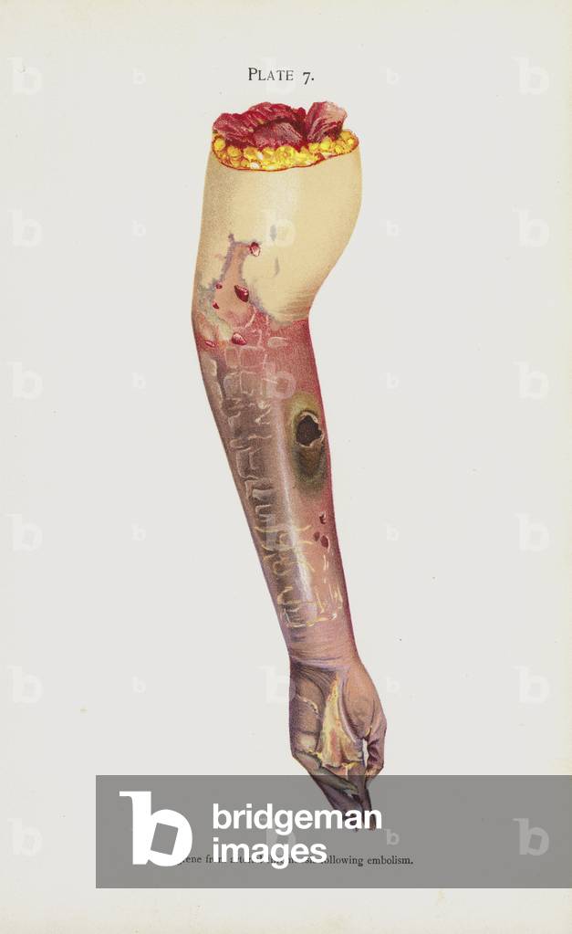 Gangrene from arterial thrombosis following embolism (colour litho)