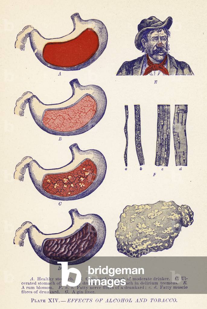 Effects of Alcohol and Tobacco (colour litho)