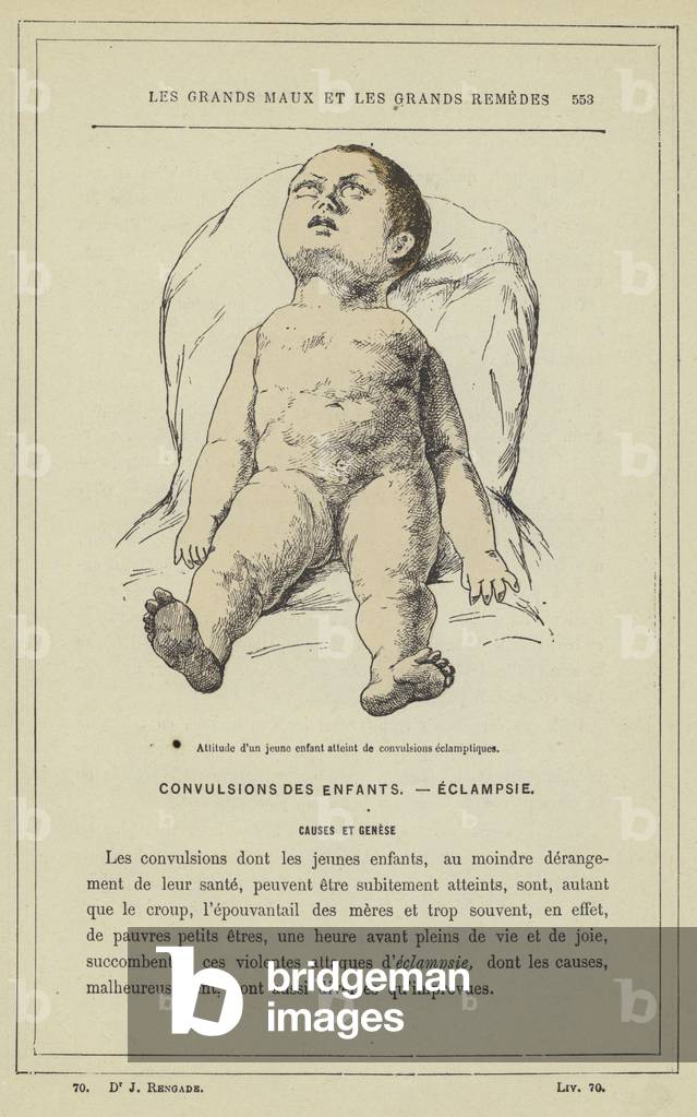 Attitude d'un jeune enfant atteint de convulsions eclamptiques (colour litho)