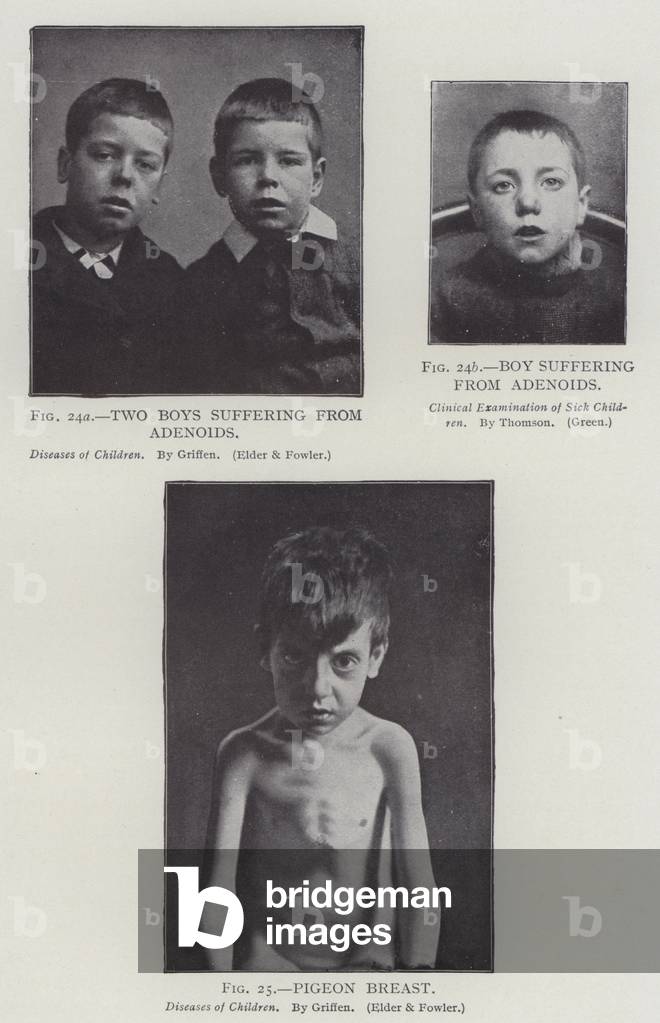Two Boys Suffering from Adenoids, Boy Suffering from Adenoids, Pigeon Breast (b/w photo)