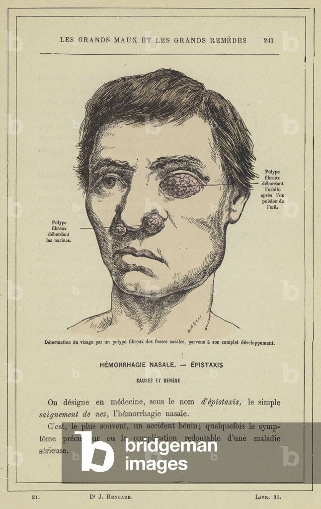 Deformation du visage par un polype fibreux des fosses nasales, parvenu a son complet developpement (colour litho)