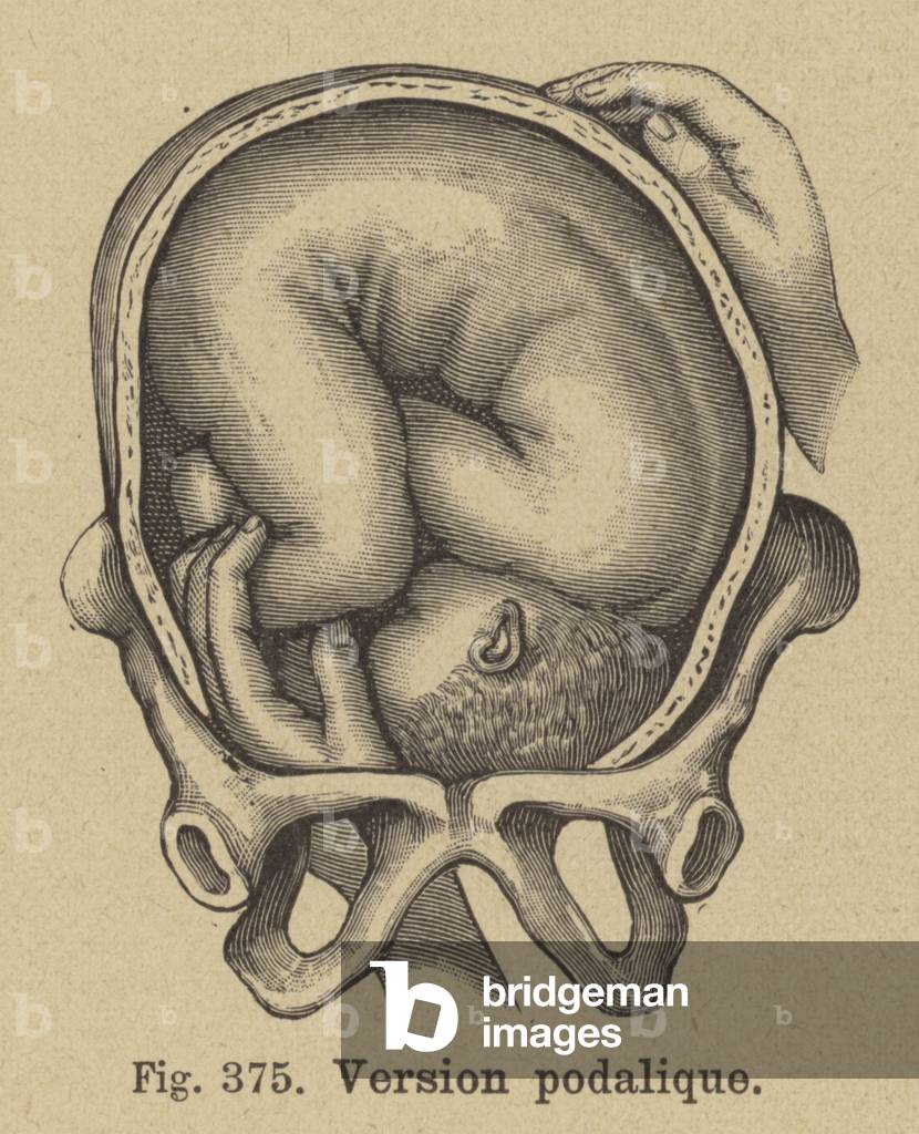 Podalic version during childbirth (engraving)