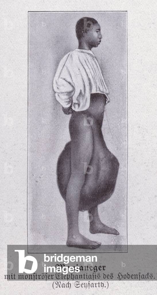 Elephantiasis (b/w photo)