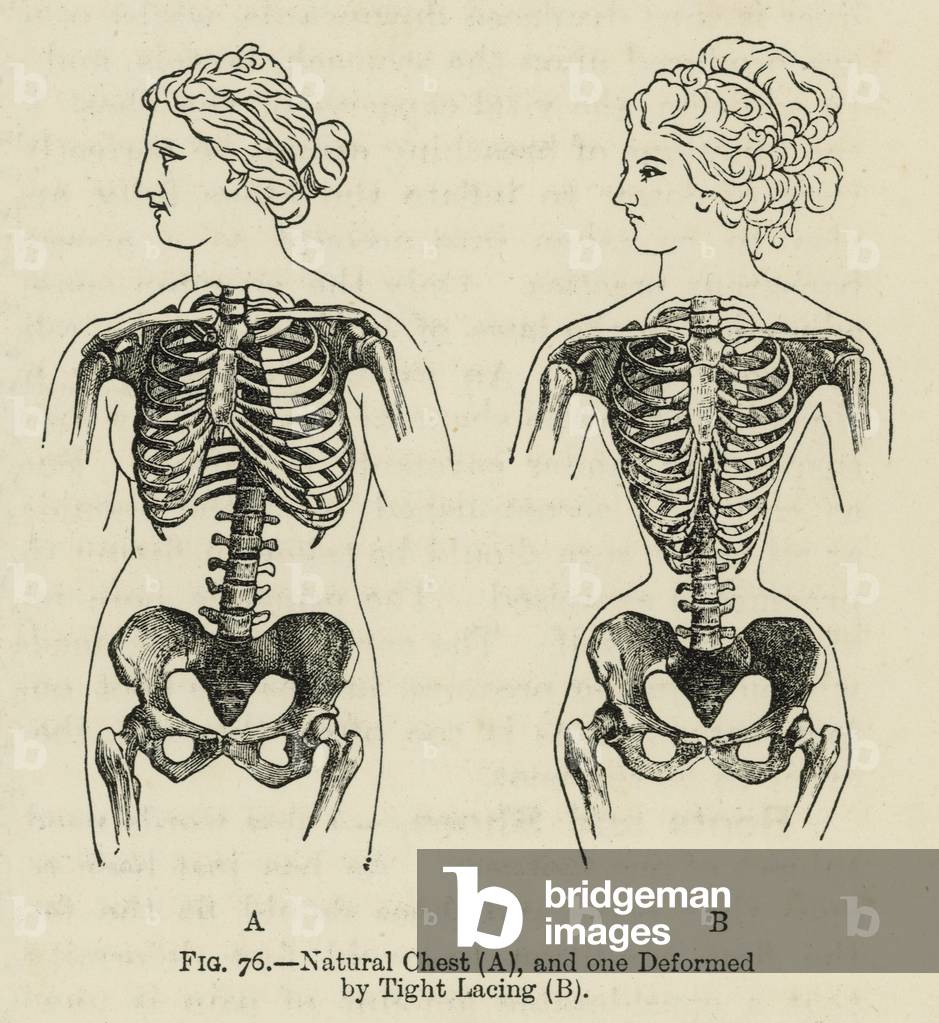 Natural Chest and one Deformed by Tight Lacing (litho)