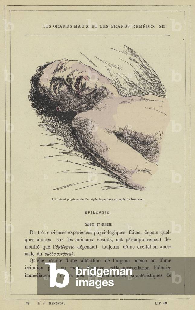Attitude et physionomie d'un epileptique dans un acces de haut mal (colour litho)