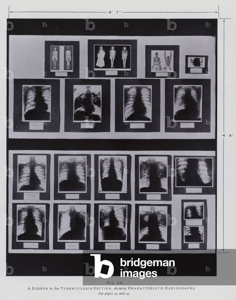 Wellcome Museum: Screen, Tuberculosis Section, Characteristic Radiographs (b/w photo)