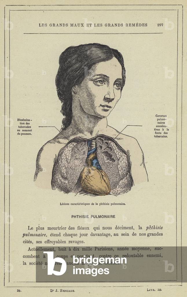 Lesions caracteristiques de la phthisie pulmonaire (colour litho)