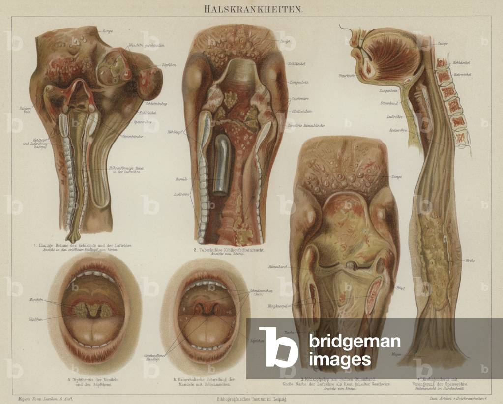 Diseases of the throat (colour litho)