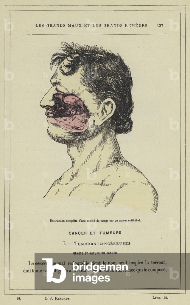 Destruction complete d'une moitie du visage par un cancer epithelial (colour litho)