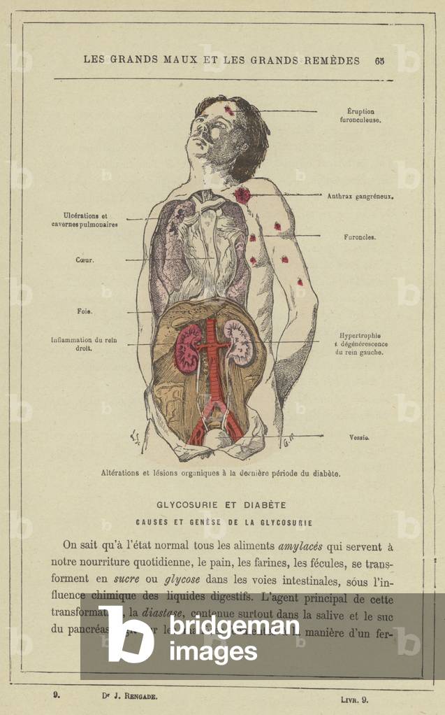 Alterations et lesions organiques a la derniere periode du diabete (colour litho)