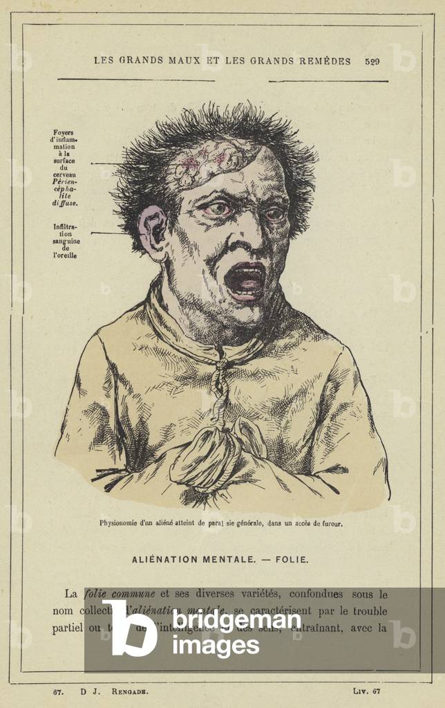 Physionomie d'un aliene atteint de paral sie generale, dans un acces de fureur (colour litho)