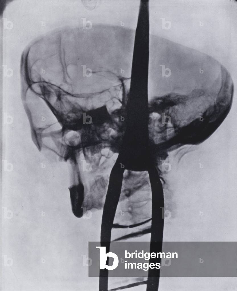 Skiagram of the Wilkinson Head with the skull-cap removed (b/w photo)