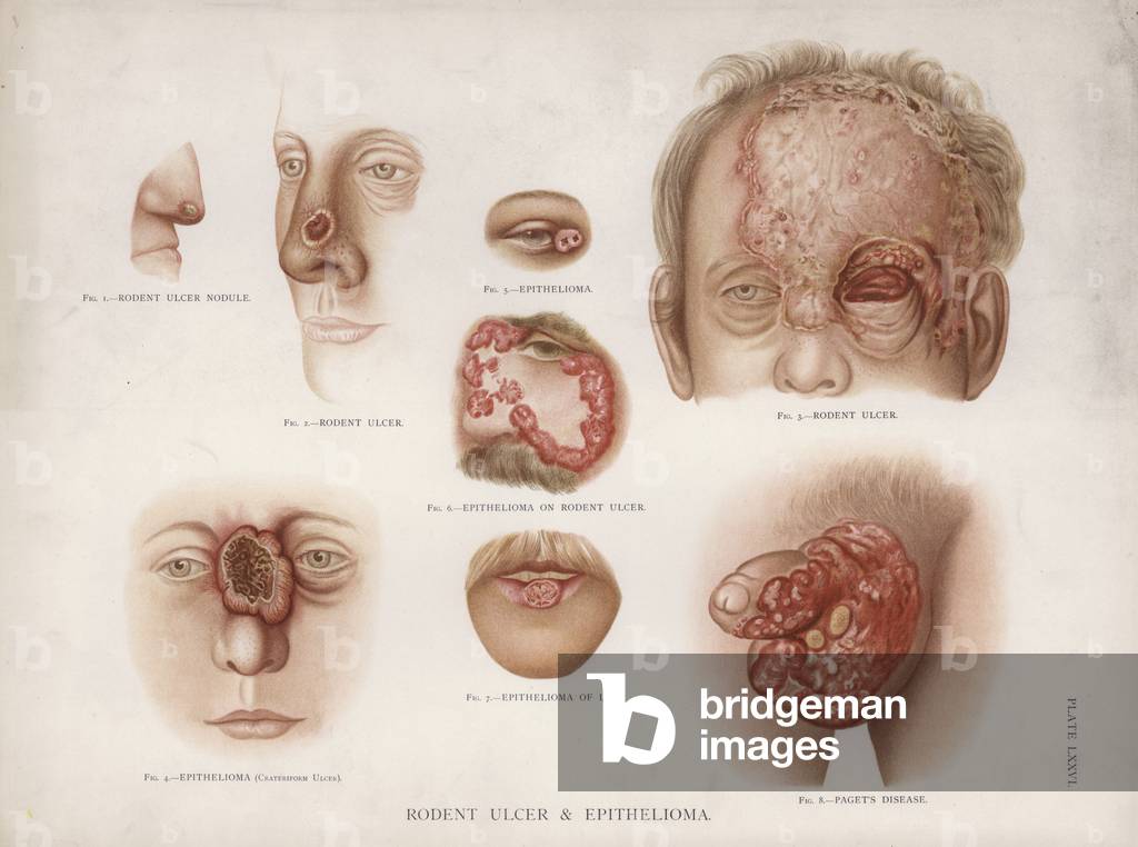 Diseases of the Skin: Rodent Ulcer and Epithelioma (colour litho)