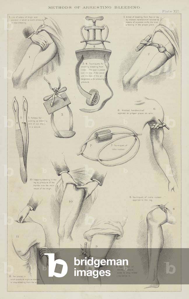 Methods of arresting bleeding (engraving)