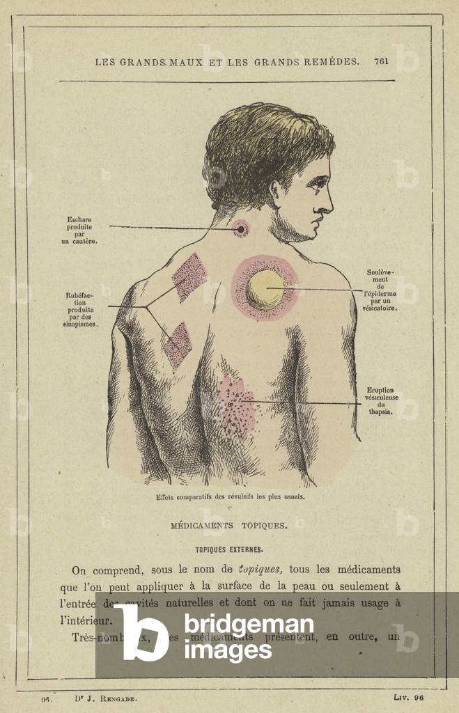 Effets comparatifs des revulsifs les plus usuels (colour litho)