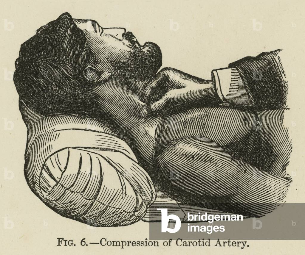 Compression of Carotid Artery (litho)