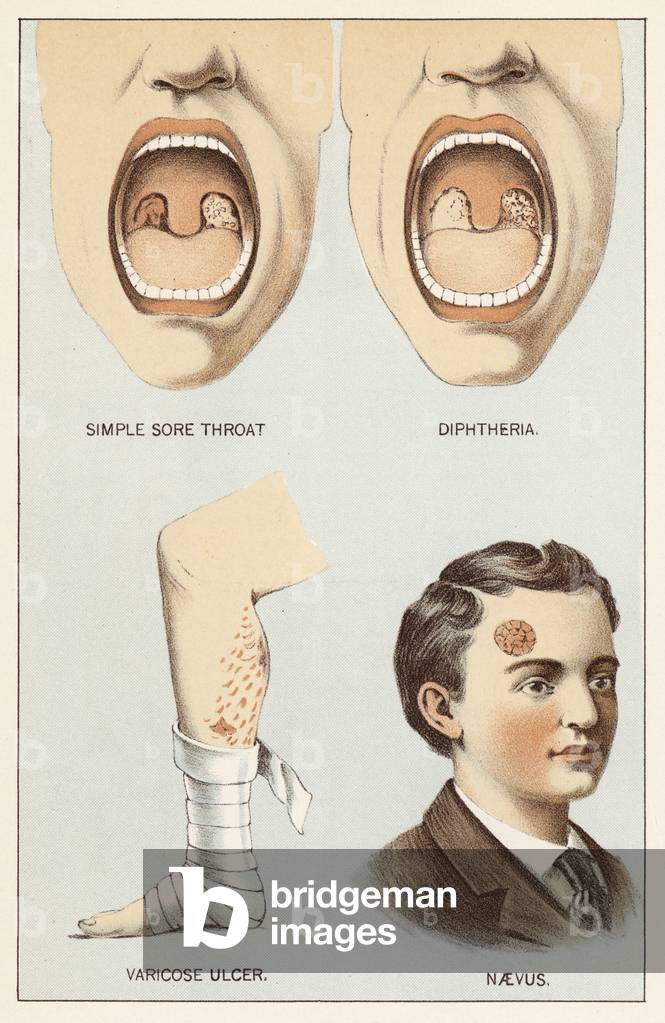 Diseases (colour litho)