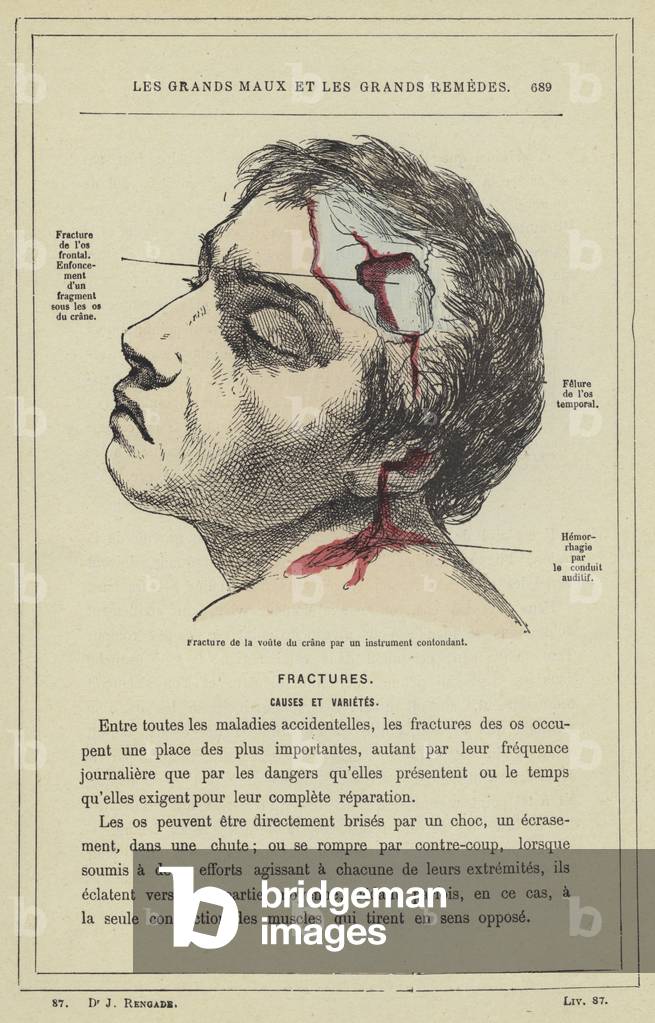 Fracture de la voute du crane par un instrument contondant (colour litho)