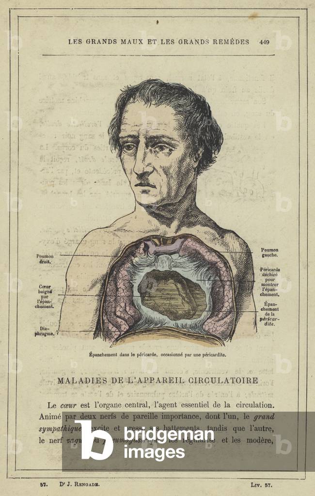 Epanchement dans le pericarde, occasionne par une pericardite (colour litho)