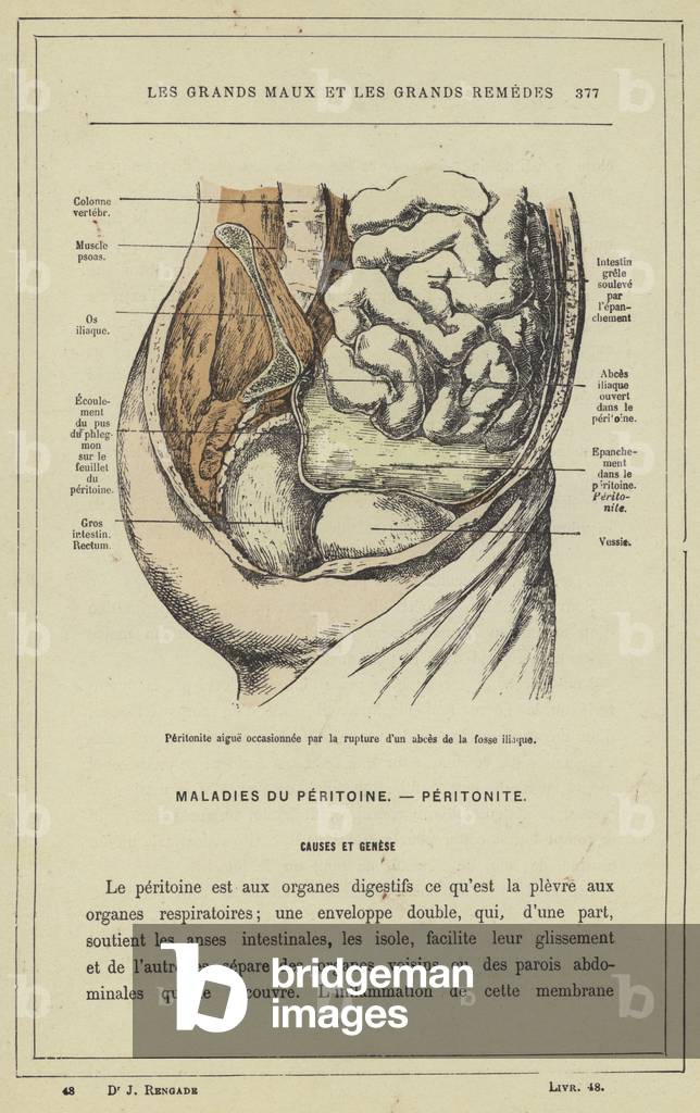 Peritonite aigue occasionnee par la rupture d'un abces de la fosse iliaque (colour litho)