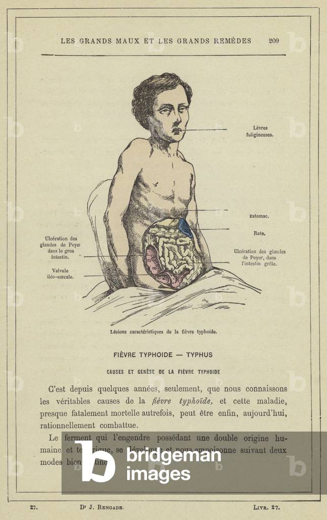Lesions caracteristiques de la fievre typhoide (colour litho)