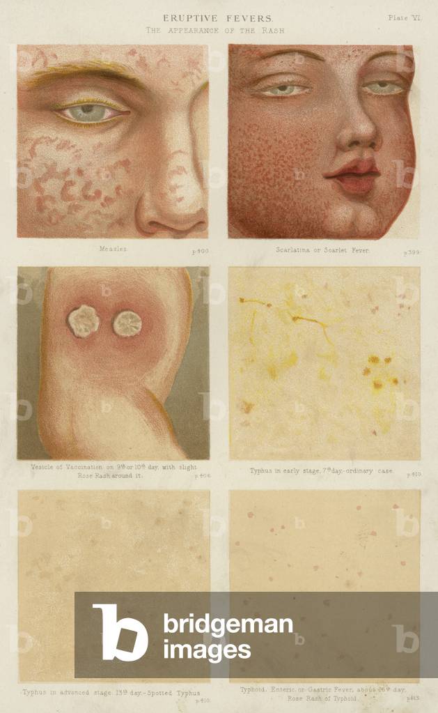 Eruptive fevers (colour litho)