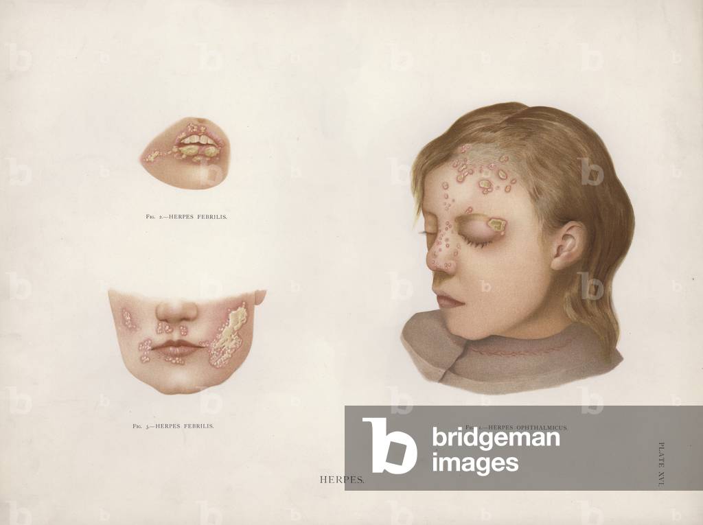 Diseases of the Skin: Herpes (colour litho)
