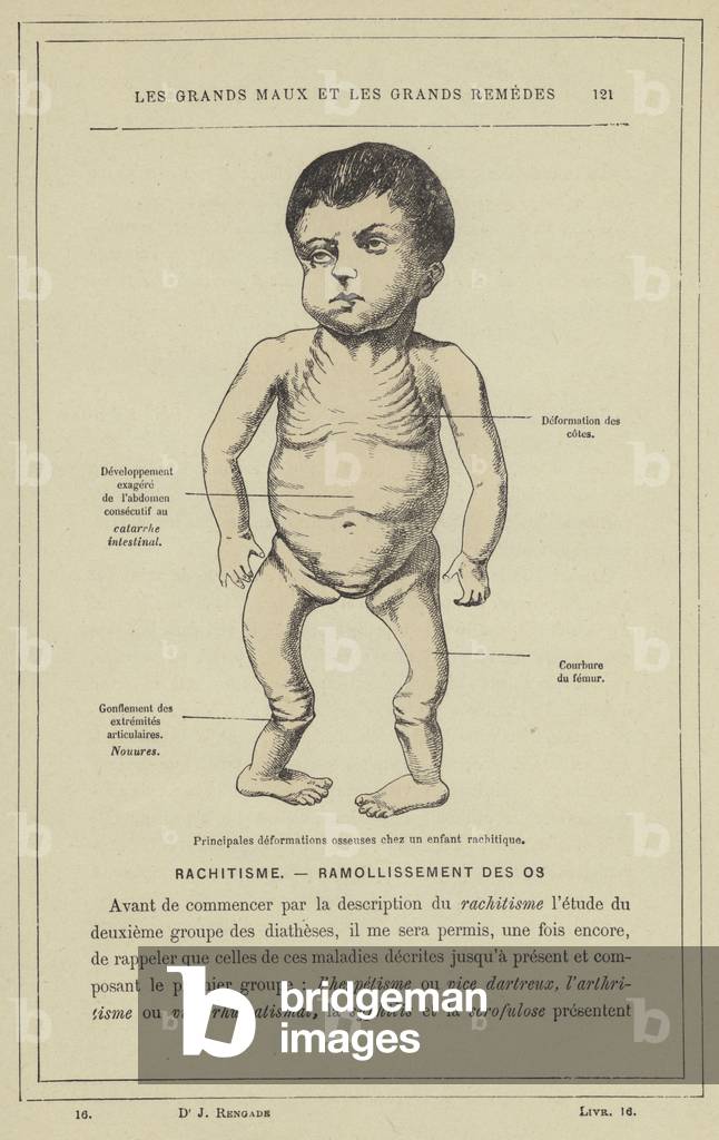 Principales deformations osseuses chez un enfant rachitique (colour litho)