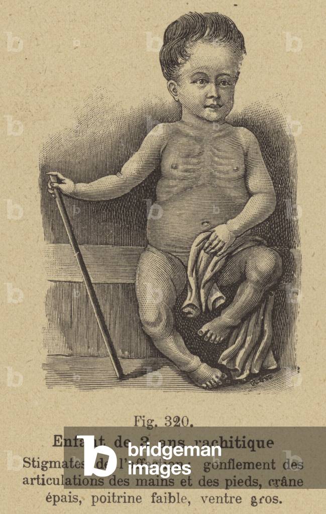 Three year-old child suffering from rickets (engraving)