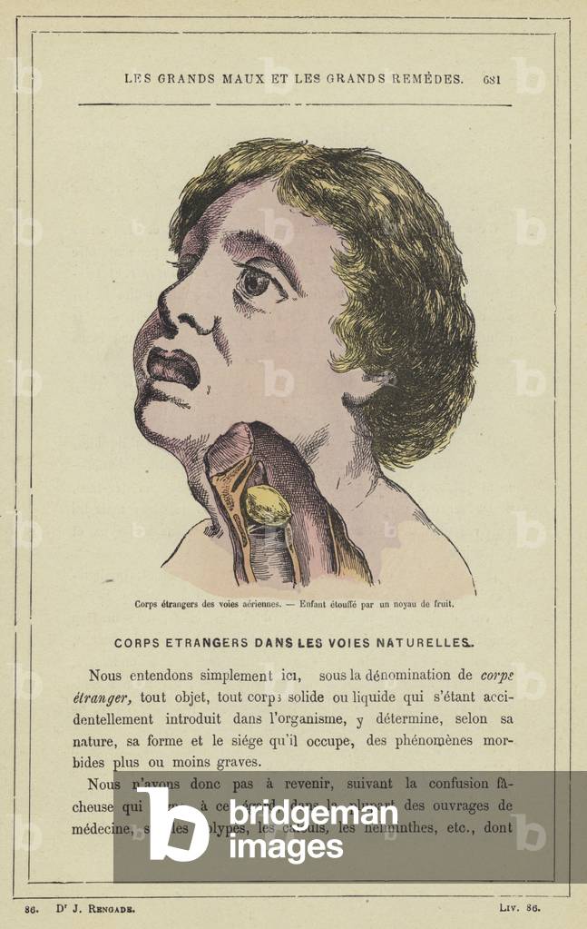 Corps etrangers des voies aeriennes, Enfant etouffe par un noyau de fruit (colour litho)