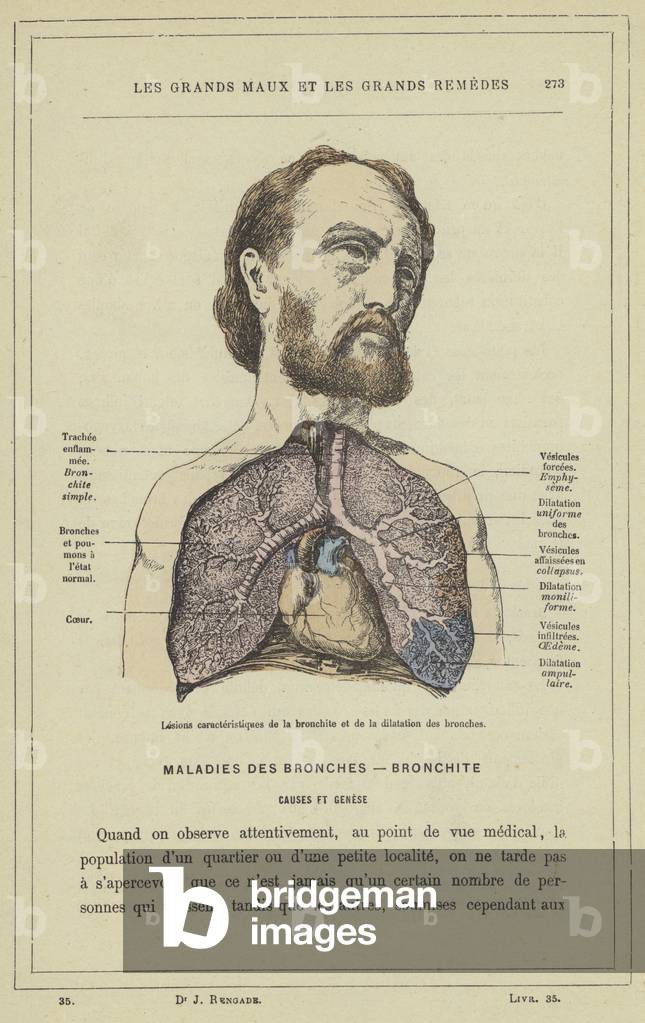 Lesions caracteristiques de la bronchite et de la dilatation des bronches (colour litho)