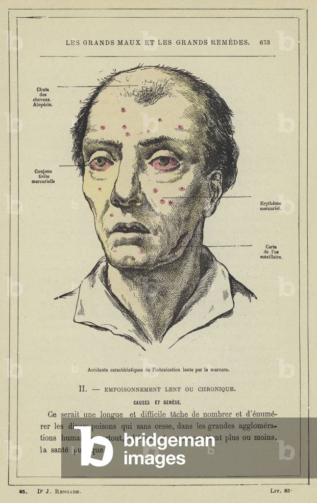 Accidents caracteristiques de l'intoxication lente par le mercure (colour litho)