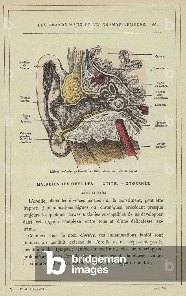 Lesions profondes de l'oreille, Otite interne, Carie du rocher (colour litho)