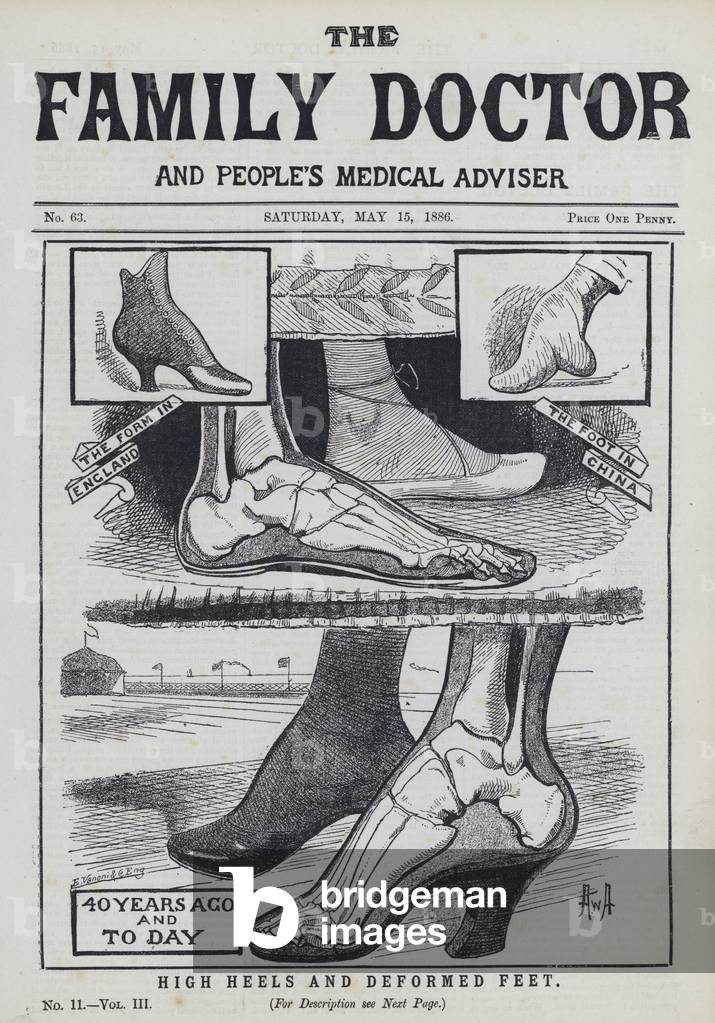 High heels and deformed feet (engraving)