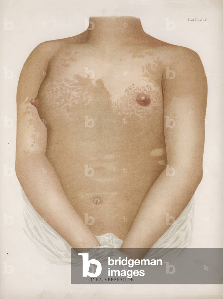 Diseases of the Skin: Tinea Versicolor (colour litho)