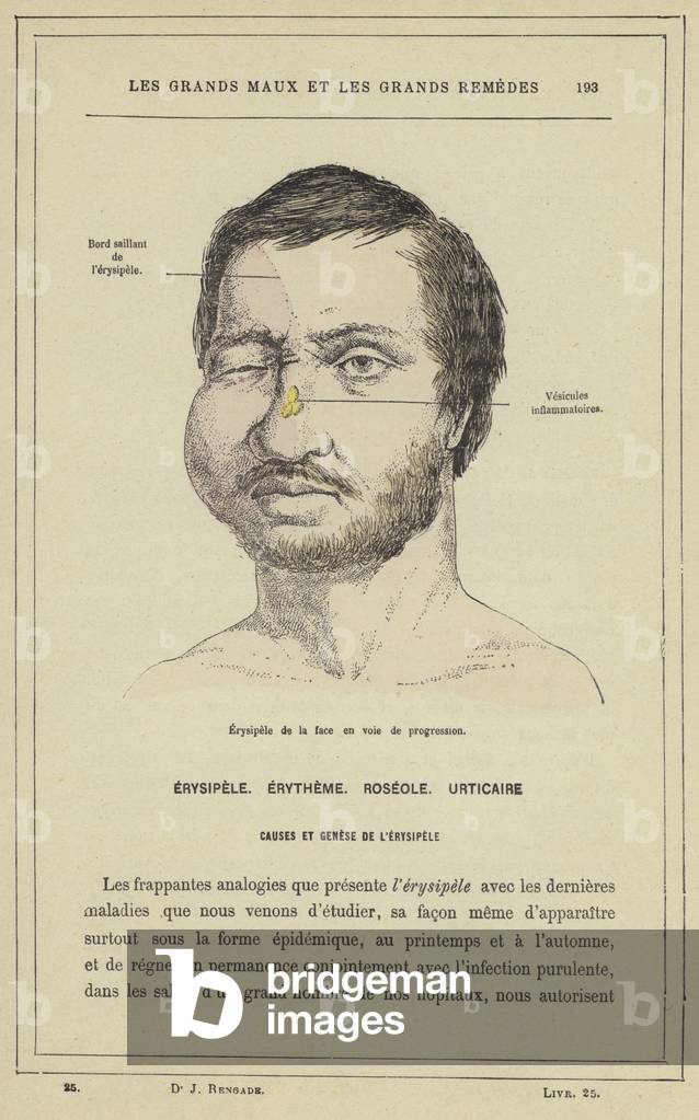 Erysipele de la face en voie de progression (colour litho)