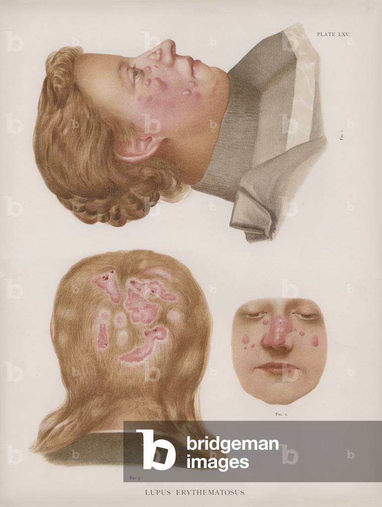 Diseases of the Skin: Lupus Erthematosus (colour litho)