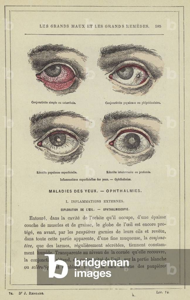 Inflammations superficielles des yeux, Ophthalmies (colour litho)